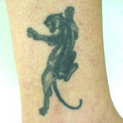 Tattoo Removal Reading Berkshire Chiltern Medical 