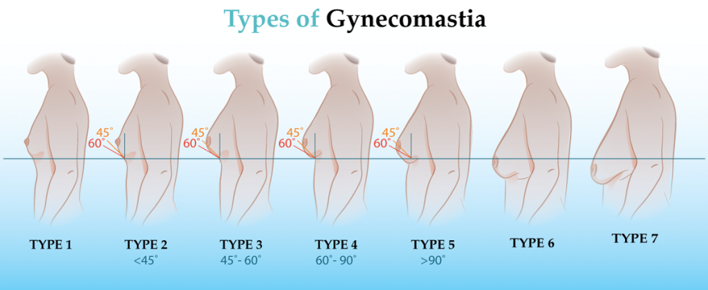 Gynecomastia | Reading | Berkshire | Chiltern Medical Clinics